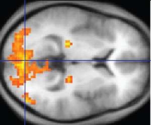 Brain Scan Charlotte Criminal Lawyer Mecklenburg DWI Attorney